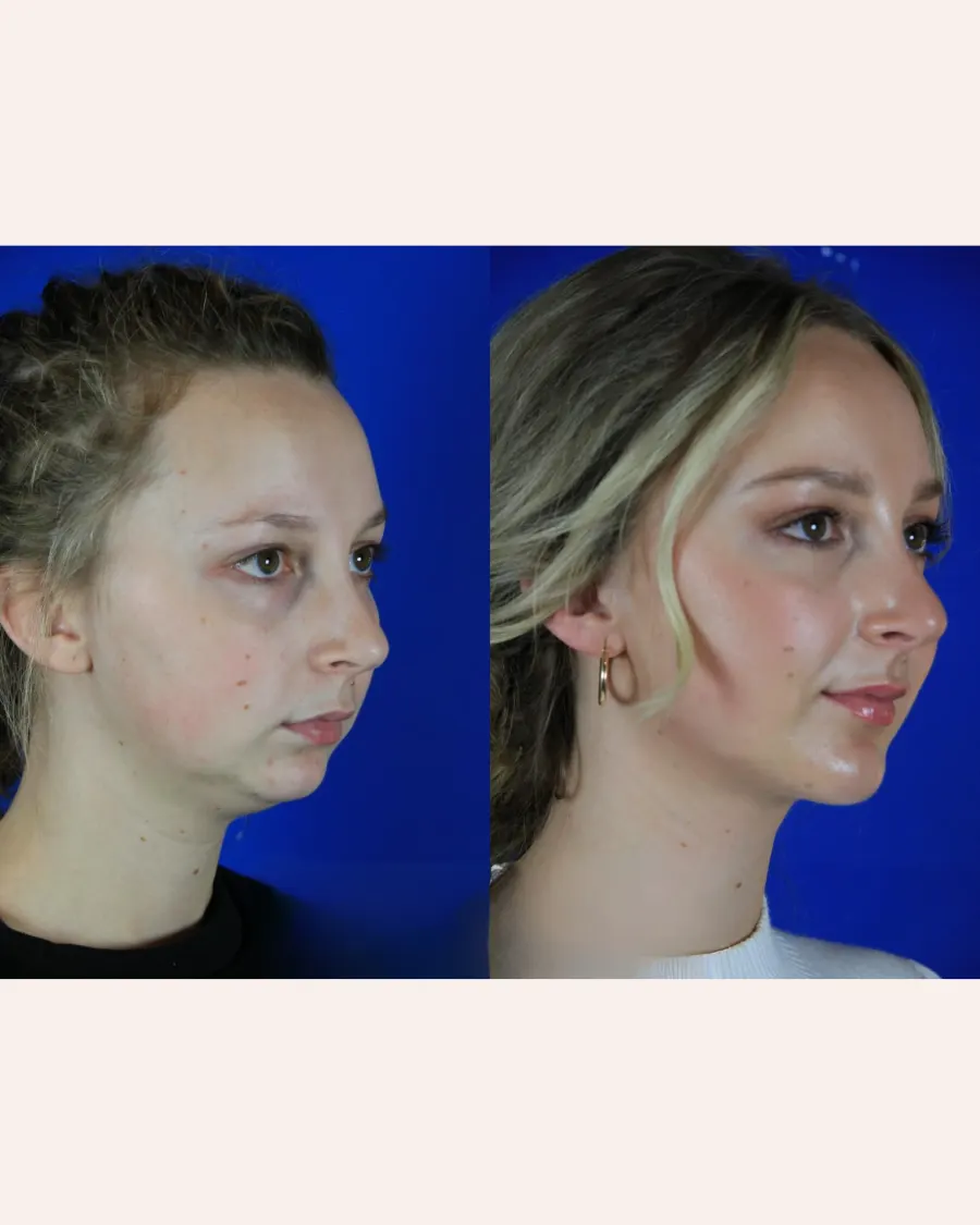 Chin Augmentation at Cinch Clinics